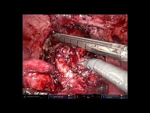 Robotic assisted secondary Cytoreductive surgery for a recurrent ovarian cancer post HIPEC