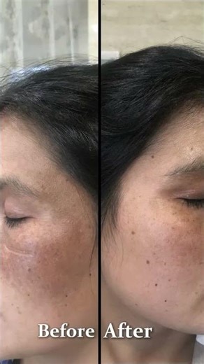 Freckle Laser Treatment Explained | Get Clear, Spot-Free Skin with Dr. Sridevi Esthetiques