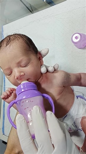 In this video, we share the recovery journey of a cute newborn baby who was previously suffering from abdominal distention. After careful NICU management, feeding adjustments, and observation, the baby has fully recovered and is now in stable condition. 🍼💪 Our neonatal team monitored the baby’s feeding tolerance, bowel movements, and abdominal examination to ensure full recovery before discharge. This educational video highlights the importance of early detection and proper management of abdom