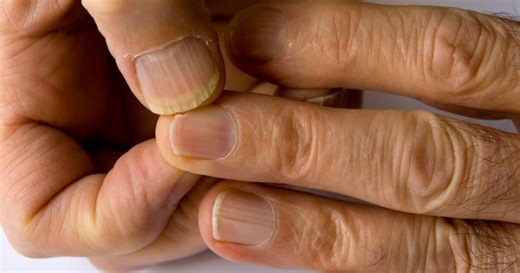 Estrías en las uñas, el riesgo que implican para la salud y su significado