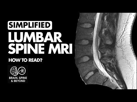 How to Read a Lumbar Spine MRI Scan?