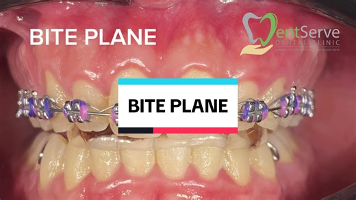Understanding Orthodontic Appliance: Bite Plane