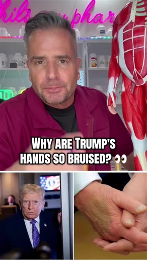 Why are Trump's hands so bruised? 👀 It's the aspirin. 325mg daily will do that to you. Look I get it. He's trying to protect his heart. But there's a smarter way to do this. Your body has something called the eNOS system. It's powered by nitric oxide and it naturally reduces clotting, lowers blood pressure, helps with blood sugar AND protects your stomach and kidneys. Beets are one of the best ways to support this system. Here's what I would recommend. Switch to 81mg aspirin and add in a qualit