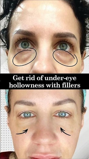 Under Eye Bags Removal Surgery Before and After | Blepharoplasty Under Eye