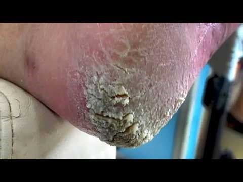 The Soles Of The Feet Are Cracked A Lot, And The Feet Are Not Washed【Pedicure Master Lin Jun】