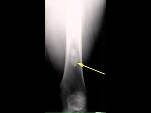 Enchondroma Distal Femur