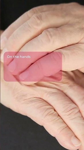 Signs and symptoms of hand foot and mouth disease