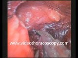Thoracoscopic Resection of Germinal Mediastinal Mass • Video • MEDtube.net