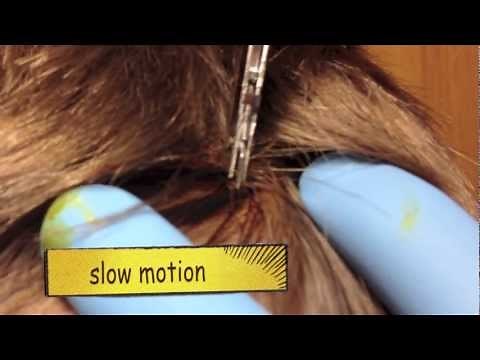 Expert advice on safely removing staples from wounds