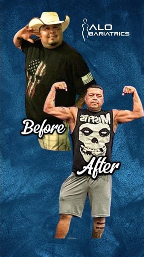 Before and after Bariatric surgery. ALO Bariatrics #beforeandafter