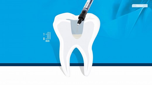 75 reactions · 6 comments | Venus Bulk Flow ONE is the first flowable one-shade bulk-filling composite without the need for an additional capping layer. As a further universal shade solution for everyday cases, it is the ideal choice for restorations in the posterior region. An absolute must-have for every practice  Explore all benefits here: www.kulzer.com/vbfo-social | Kulzer | Facebook