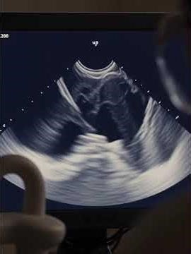 Echocardiogram: Uses ultrasound to assess heart structure and function for heart diseases #health