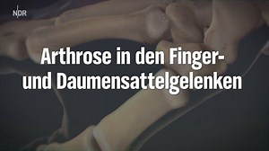 6.4K views · 26 reactions | Arthrose in der Hand: Was hilft Ihnen gegen die Schmerzen? | ARD GESUND | Facebook