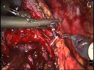 Robotic Radical Prostatectomy - STEP 6-  Athermal Sexual Nerve Sparing Technique • Video • MEDtube.net