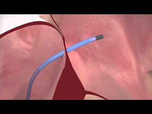 Catheter Ablation Animation Sm