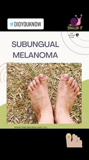 Understanding Subungual Melanoma: Causes, Symptoms, and Treatment