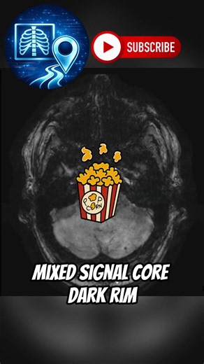 Microbleeds vs Cavernous Malformations on SWI #Radiology #MedicalTech #Diagnosis