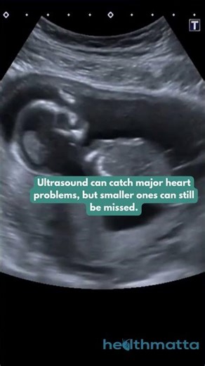 What Ultrasounds Actually Miss During Pregnancy #pregnancy #ultrasound #health