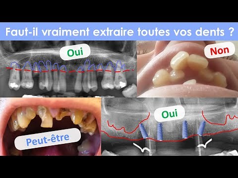 All on 4 - extraction totale