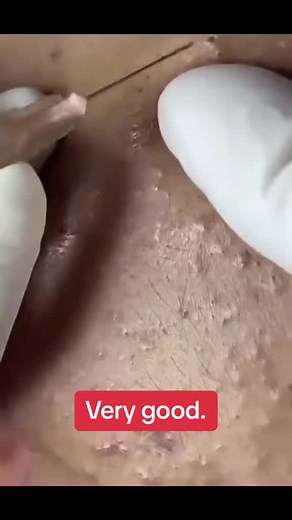 #squeezepip #squeezeyuk #satisfyingvideo #squeeze #pimple #pimplepop #foryoupage