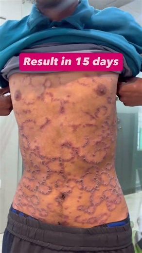 Psoriasis recovery in 15 days - Real case study