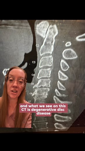 Case study 103 - Cervical myelopathy treated by anterior cervical discectomy and fusion (ACDF) Anterior cervical discectomy and fusion (ACDF) is a surgery to remove a herniated or degenerative disc in the neck. An incision is made in the throat area to reach and remove the disc. A graft is inserted to fuse together the bones above and below the disc. #neurosurgery #casestudy #sundaycasestudy #ladyspinedoc #healthcareworker #hospital #surgery #neurosurgeon #medicalschool #medstudent #medicalstude