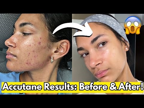 Accutane Before & After: My Shocking Results + Side Effects!
