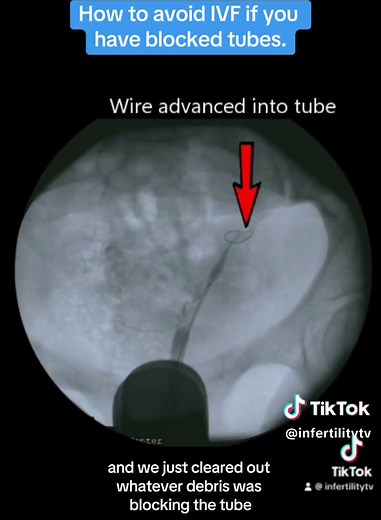 Avoid IVF with Blocked Fallopian Tube Treatment