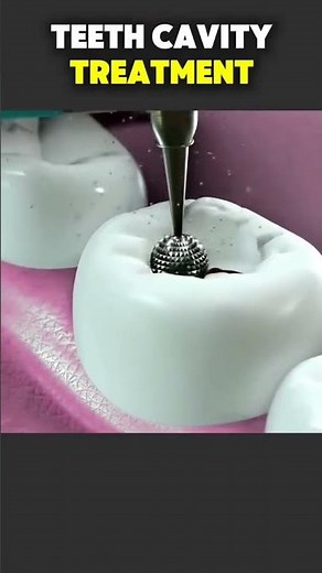 How Tooth Filling is Done | Step-by-Step Dental Procedure Explained"