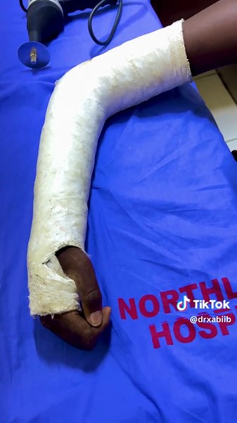 Cast removal, patient had humeral condyle fracture now its healed very well, patient was happy and satisfied alhamdhulilah #plaster #fyp #orthopedics #eastleigh #fracture