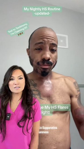 #duet with @IamPaulTaylor Hidradenitis suppurativa (HS) is a painful, long-term skin condition that causes skin abscesses and scarring on the skin. The exact cause of hidradenitis suppurativa is unknown, but it occurs near hair follicles where there are sweat glands, usually around the groin, bottom, breasts and armpits. #drpimplepopper #dermatology #hidradenitissuppurativaawareness