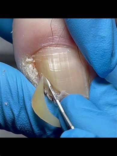 Crooked toenails, trim the damaged side of the nail #nails #pedicure