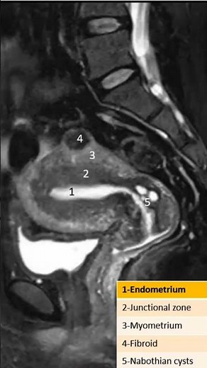Cervical nabothian cysts