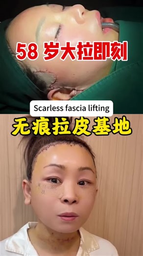 1. Multi-layer composite skin pulling technology Epidermis fascia layer double lifting and fixation to improve facial sagging, mouth sac, and mandibular margin blurring, firm but not stiff, and anti-aging more lasting 2. Refine hidden incision face lift, hidden scar suture, faster recovery, solve aging and sagging from the root cause, and reshape the tight girl's contour.#facelift #拉皮 #NaturalFacelift