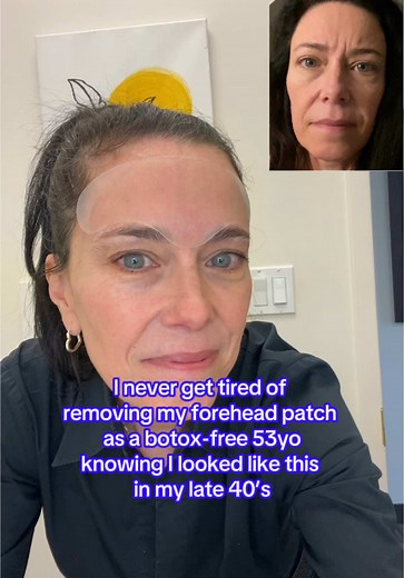 Transform Forehead Wrinkles Naturally with Silicone Patches