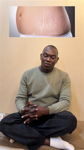 Effective Skincare for Diminishing Stretch Marks