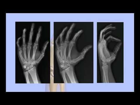 Boxer's Fracture Closed Reduction