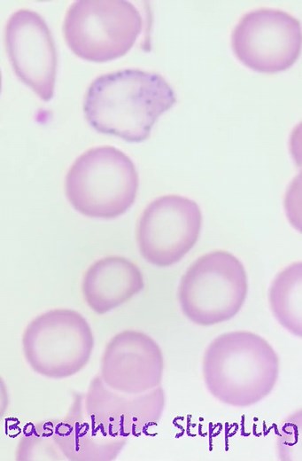 Red cell morphology inclusions ❤️❤️ #lablife #Hematology #MedicalLabTechnician | Lab life