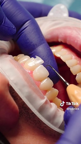 Feldspathic Veneers: The Art of Aesthetic Dentistry