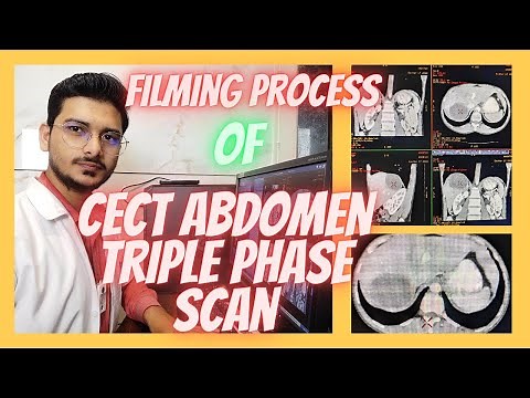 CT SCAN Abdomen Triple phase Filming process| Triphasic abdominal Filming #radiologytechnologist