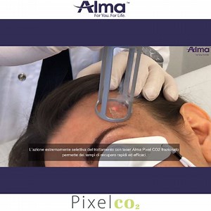 𝑆𝑒𝑖 𝑢𝑛 𝑀𝑒𝑑𝑖𝑐𝑜? 𝑆𝑐𝑜𝑝𝑟𝑖 𝑡𝑢𝑡𝑡𝑒 𝑙𝑒 𝑖𝑛𝑑𝑖𝑐𝑎𝑧𝑖𝑜𝑛𝑖 𝑐ℎ𝑒 𝑝𝑢𝑜𝑖 𝑜𝑝𝑒𝑟𝑎𝑟𝑒 𝑐𝑜𝑛 𝑙𝑎 𝑛𝑜𝑠𝑡𝑟𝑎 𝑡𝑒𝑐𝑛𝑜𝑙𝑜𝑔𝑖𝑎 𝑙𝑎𝑠𝑒𝑟 𝐏𝐢𝐱𝐞𝐥 𝐂𝐎𝟐!⠀ ✨ Scopri di più ⬇ ⠀ ⠀ Laser frazionato ablativo, permette un elevato assorbimento dell’acqua contenuta nei tessuti. Ringiovanisce e rimodella la pelle in modo minimamente invasivo e altamente efficace. ⠀ 📍 Il sistema è dotato di un’interfaccia user-friendly che illustra passo dopo passo le istruzioni ed i corrett