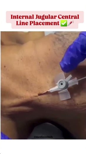 Internal Jugular Central Line Insertion Explained | ICU Procedure #shorts #centralline #criticalcare
