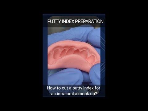 Dr VK's Dental Skool | Putty index for 3 unit temporary bridge/ mock-up
