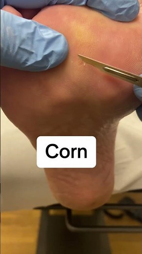 Ultimate Podiatrist Corn & Callus Removal with Scalpel #FootCare #Podiatry