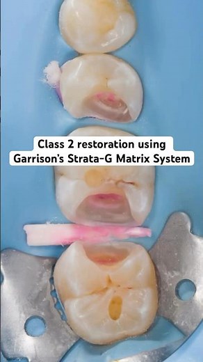 Class 2 restoration using Garrison’s Strata-G Matrix System