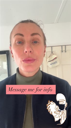 Sarah bowler on Instagram: "💉 Cannula Lip Augmentation — Performed on Myself In this reel, I’ve augmented my own lips using a cannula technique. You’ll notice: ✔️ No visible injection marks ✔️ No immediate bruising ✔️ Minimal swelling ✔️ Lip gloss applied straight away Using a cannula allows product to be placed more gently within the tissue. The blunt tip helps move vessels aside rather than pierce them, which is why this technique is widely considered a safer approach for lip augmentation, wi