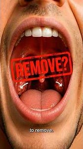 What Happens Inside Your Tonsils When You Get Sick #health #bodyhacks