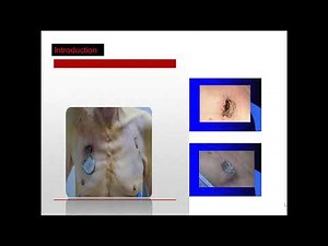 Dr Hassan shahata techniques Of Lead extraction and Indications Of Lead extraction