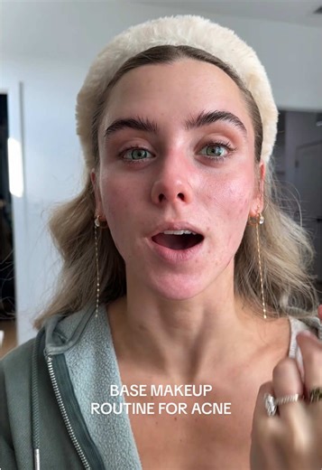 Base Makeup Routine for Acne: Glowy Coverage Tips