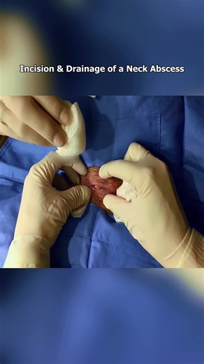 Incredible Cyst Removal Procedure in the USA